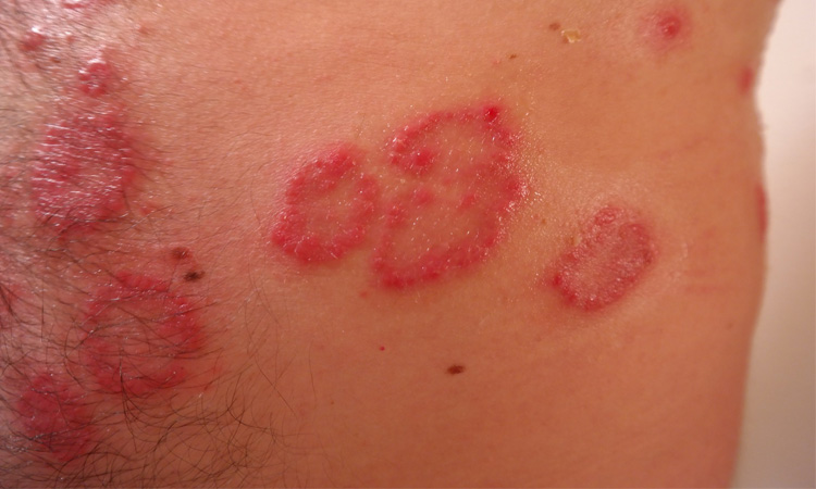 tratamente psoriazis