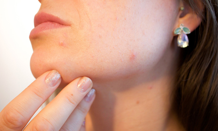 tratamente pentru acnee si puncte negre